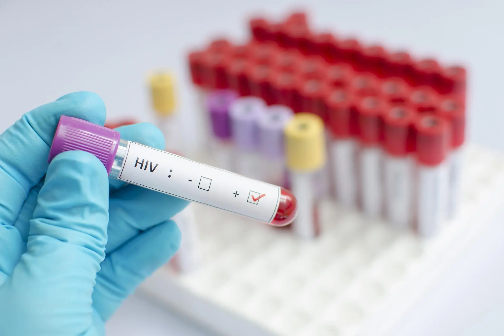 Teste HIV